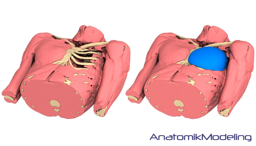 3d aufnahme von anatomikmodeling des thorax mit implantat zur simulation des möglichen ergebnisses bei der behandlung der trichterbrust